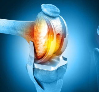 Joint Replacement Surgeries: